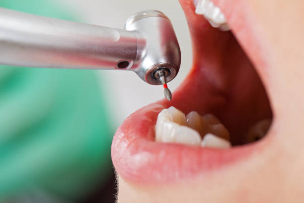 Best Lost Filling or Crown Replacement in Russellville, AL